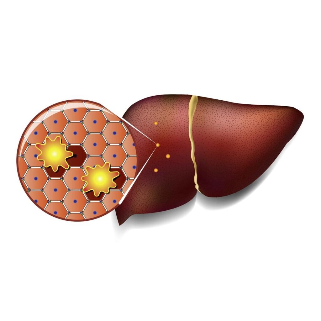 Avoid these 6 food if you have fatty liver