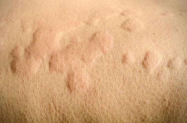 What are the Four precautions for urticaria? 